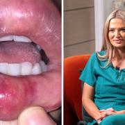Cheap fillers could leave you with black lips or even blind, a Glasgow doctor has said (SWNS)