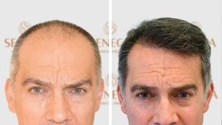 Seneca's highly trained staff can achieve the implantation of around 9,000 hairs per session and it is a procedure that can be done in a few hours and without hassle