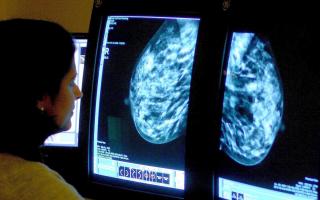 Breast cancer drug accepted for use on NHS in Scotland