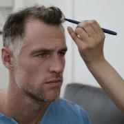 Ex-Scotland rugby star Tim Visser gets a hair transplant in Seneca