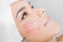 Rosacea on the skin

Picture:Alamy/PA