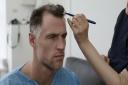 Ex-Scotland rugby star Tim Visser gets a hair transplant in Seneca