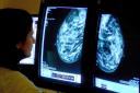 The three-year study shows that the AI software can be used to improve detection of breast cancer