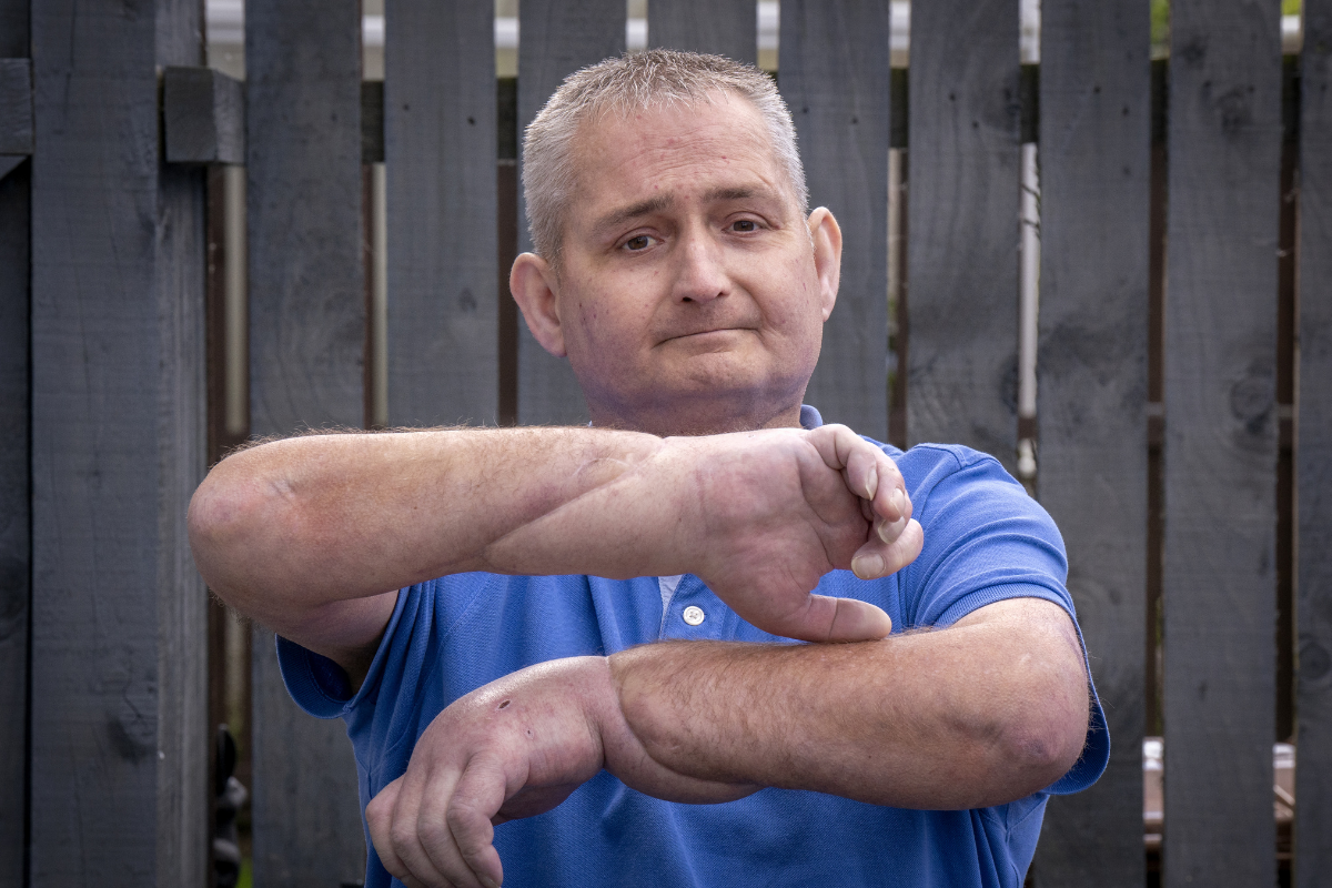 Scleroderma patient receives treatment in Glasgow following double hand transplant
