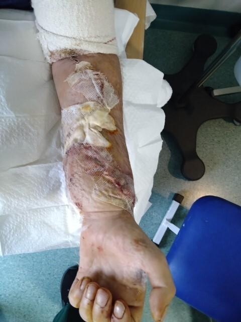 HeraldScotland: Picutred: Steven's hand after the operation