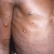 The right arm and torso of a patient overseas whose skin displays a number of lesions due to what had been an active case of monkeypox (stock pic)