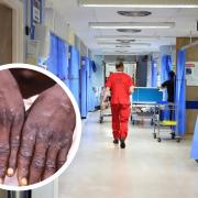 Scotland sees new monkeypox case as WHO to decide if highest alert needed