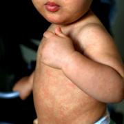 The number of cases of measles has soared in the UK and Europe