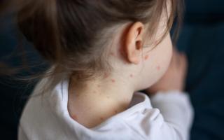 Two further cases of measles have been confirmed in Scotland